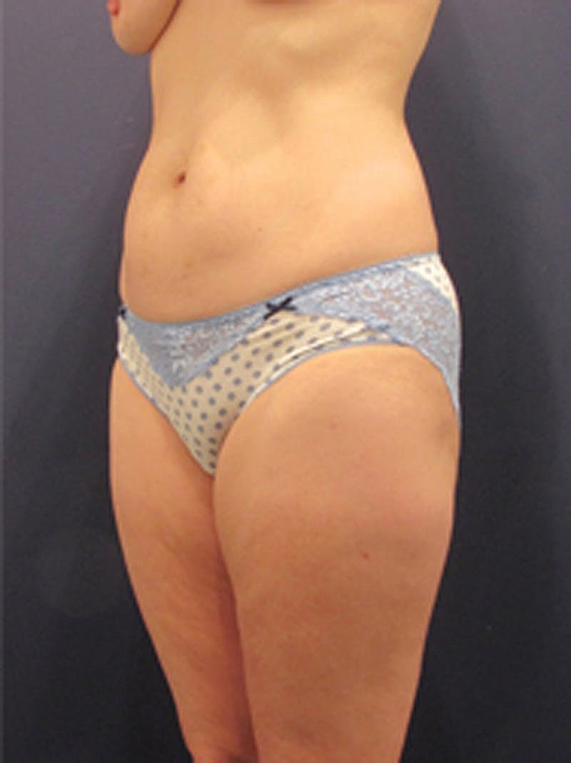 Liposuction Before & After