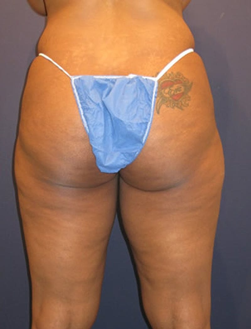 Liposuction Before & After