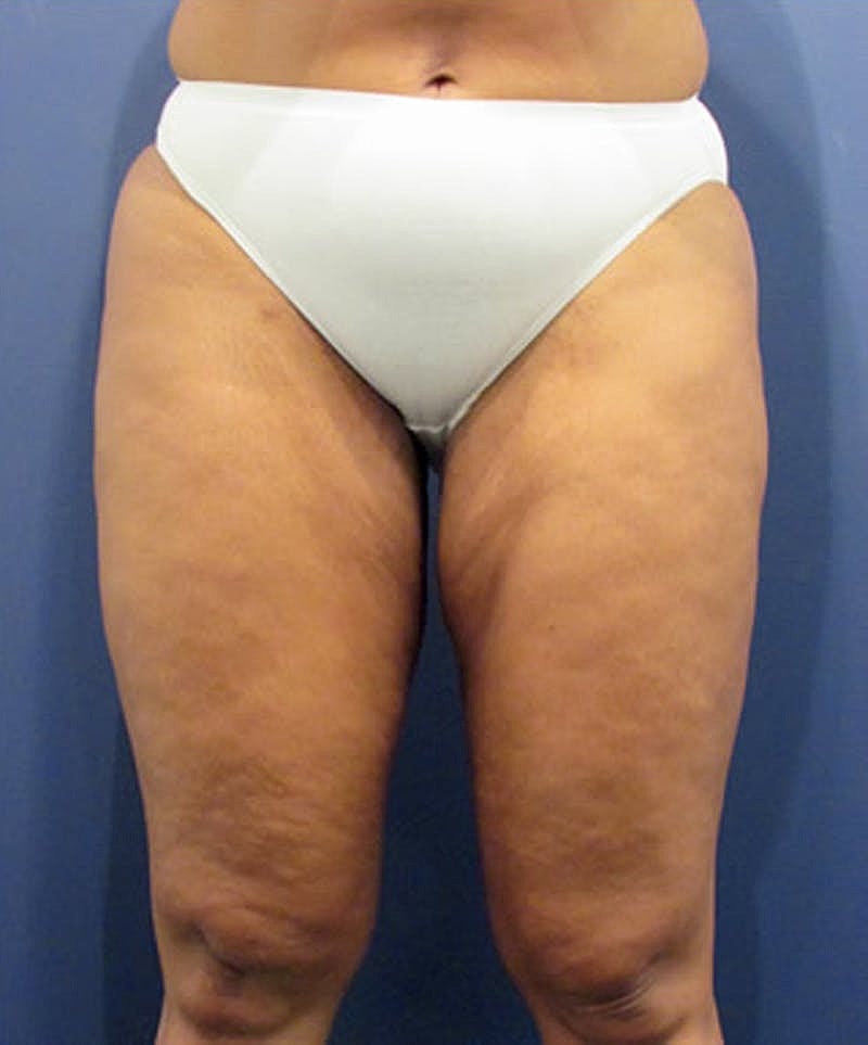 Liposuction Before & After