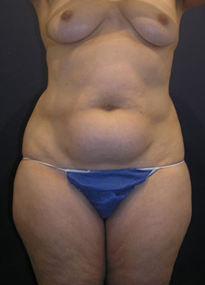 Liposuction Before & After