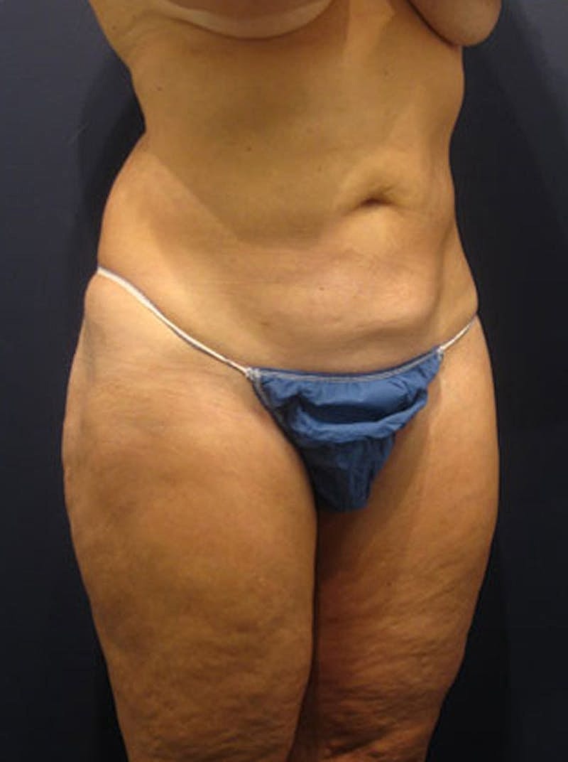 Liposuction Before & After