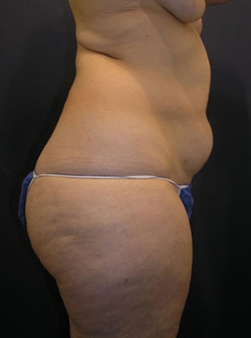 Liposuction Before & After