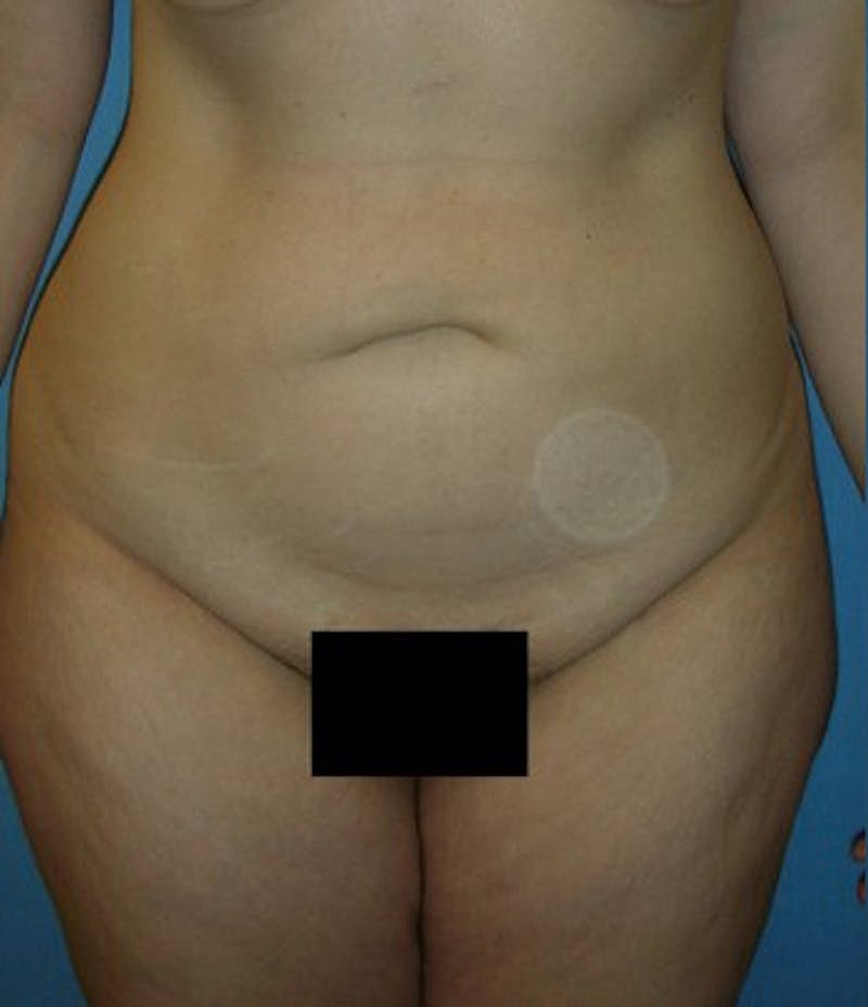 Liposuction Before & After