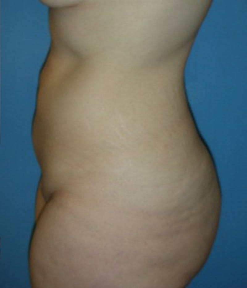 Liposuction Before & After