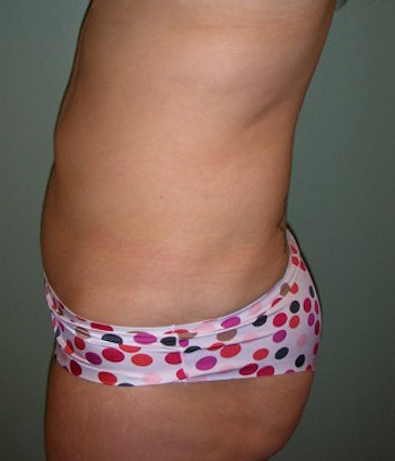 Liposuction Before & After