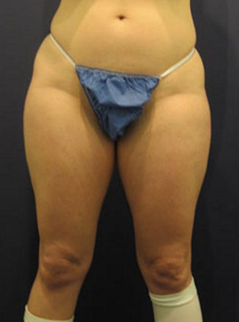 Liposuction Before & After