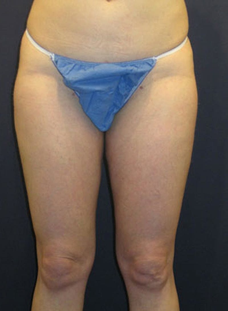 Liposuction Before & After