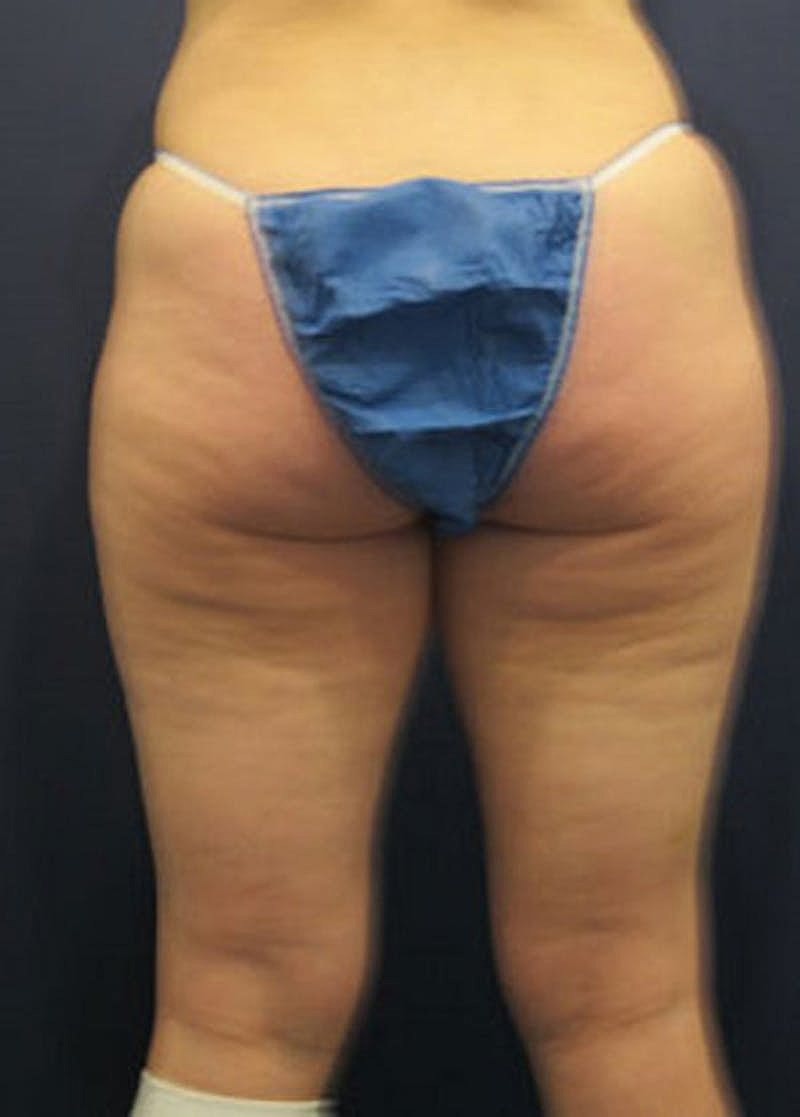 Liposuction Before & After