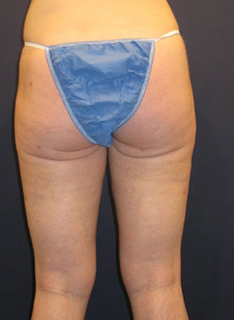 Liposuction Before & After