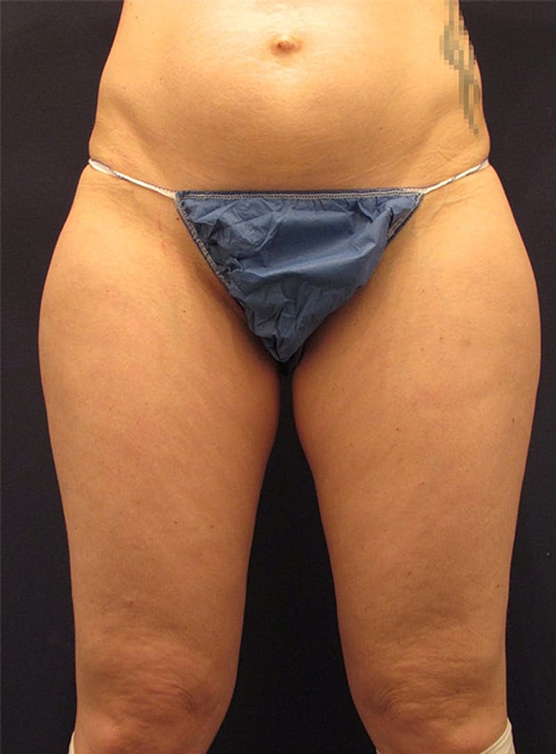 Liposuction Before & After
