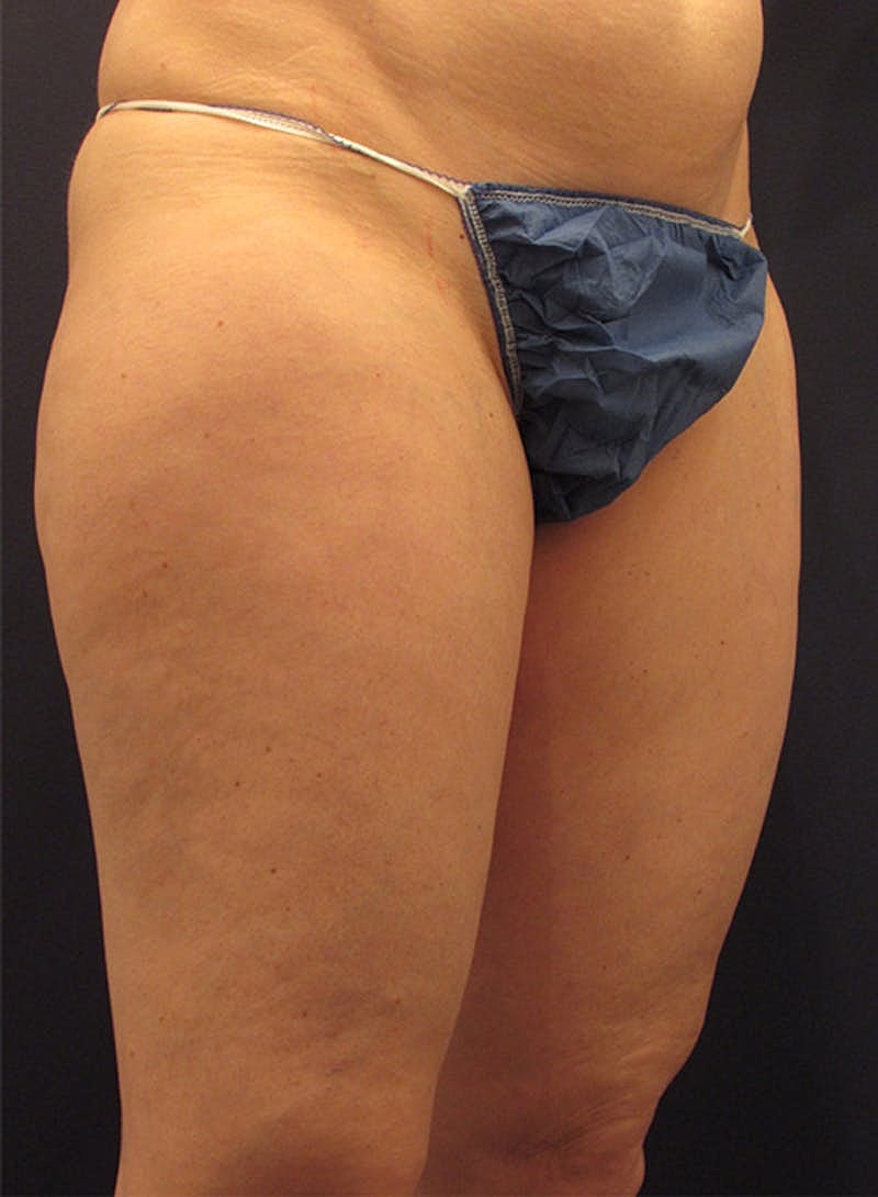 Liposuction Before & After
