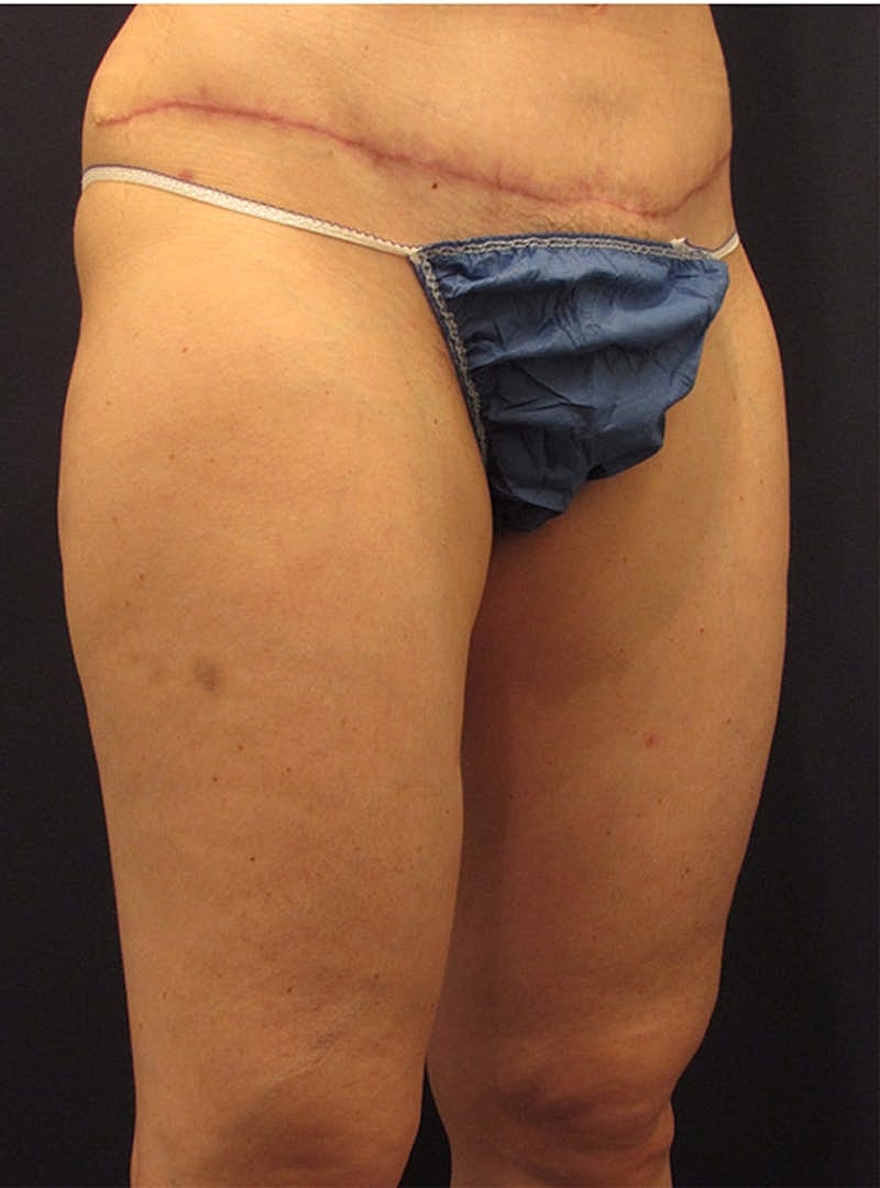 Liposuction Before & After