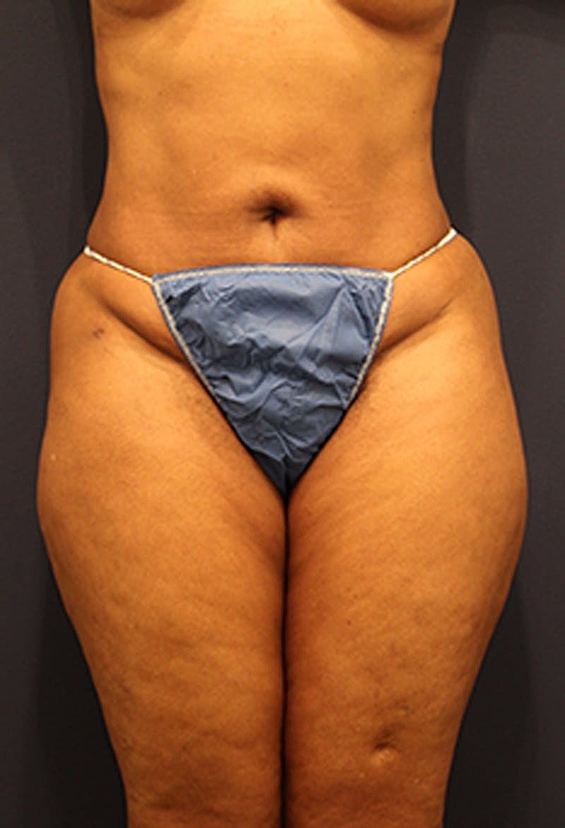 Liposuction Before & After