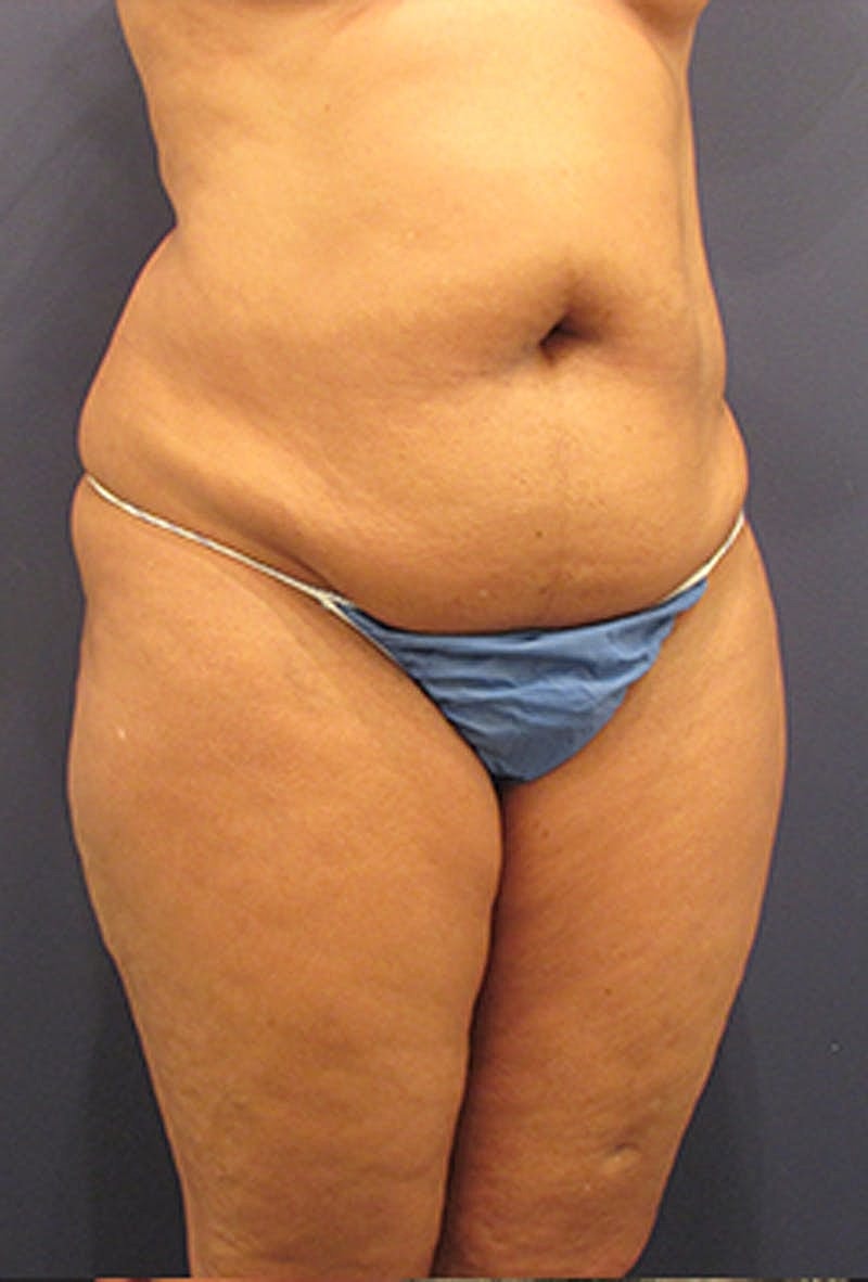 Liposuction Before & After