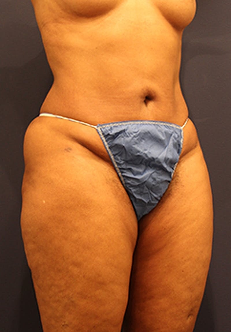 Liposuction Before & After