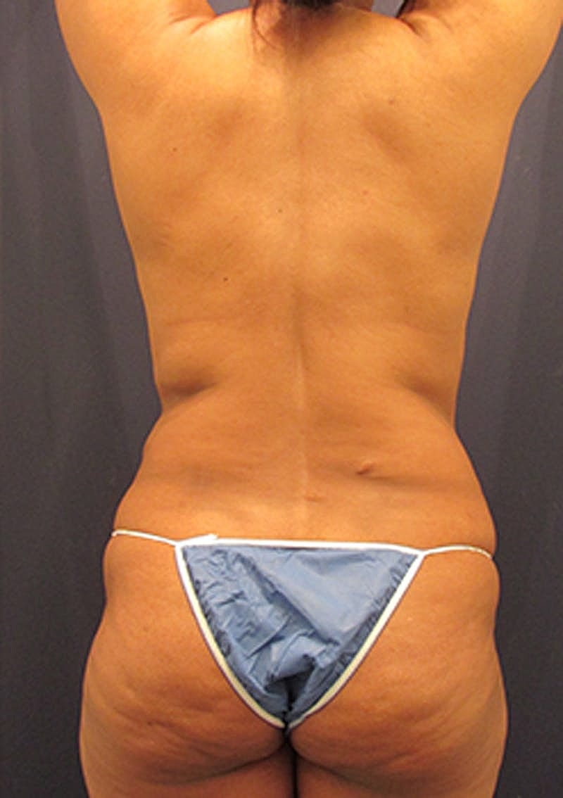 Liposuction Before & After