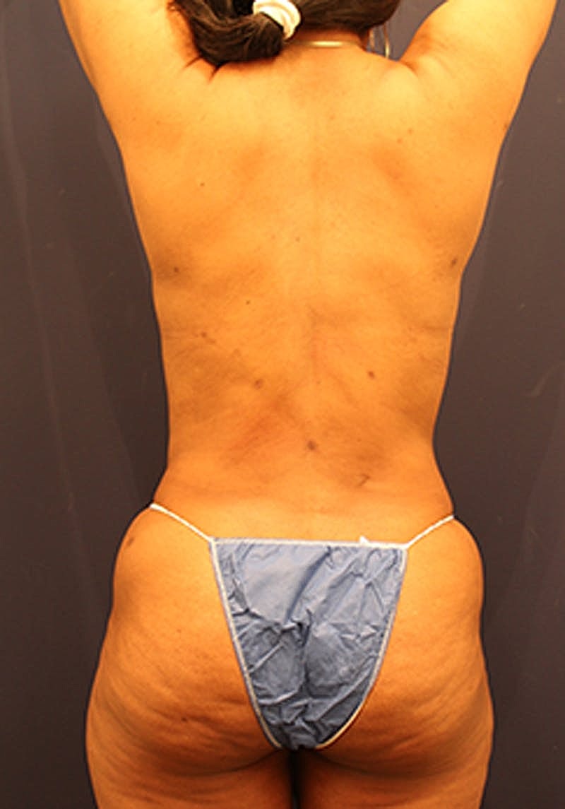 Liposuction Before & After