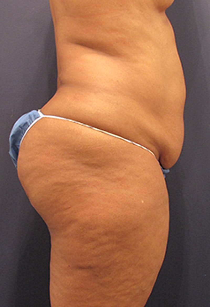 Liposuction Before & After