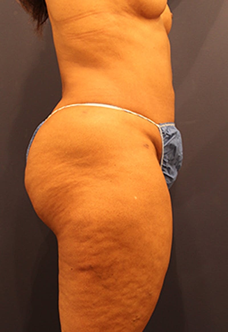 Liposuction Before & After
