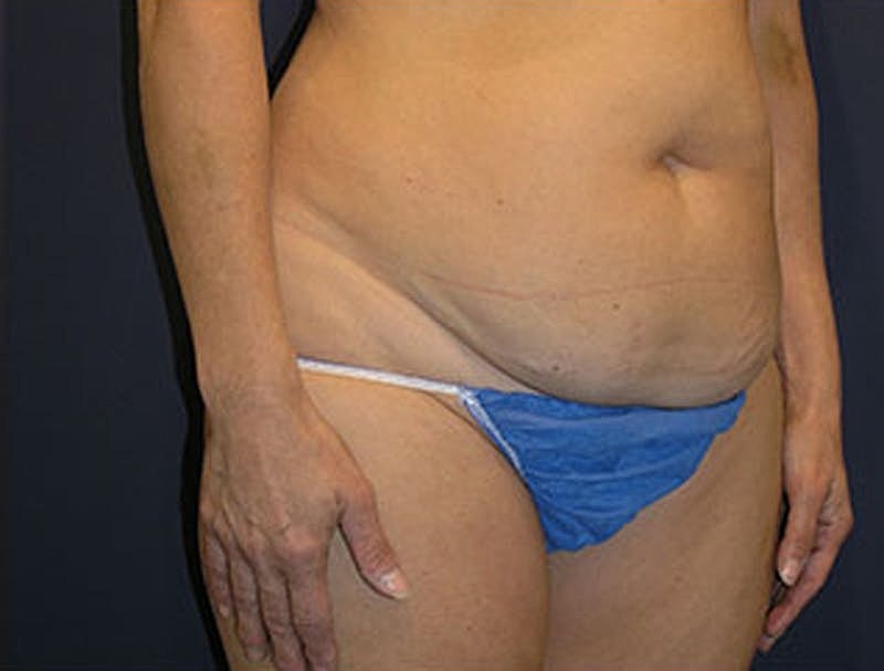 Liposuction Before & After