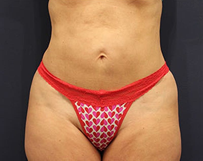 Liposuction Before & After
