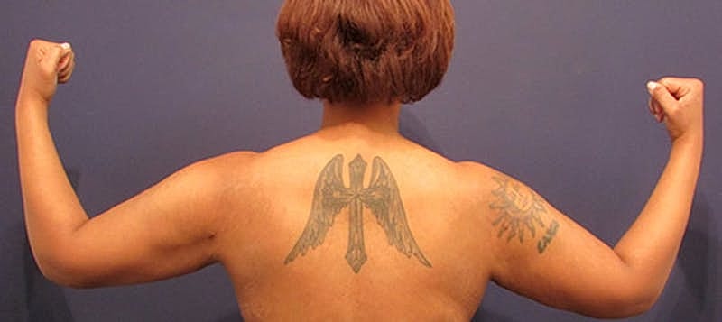 Liposuction Before & After