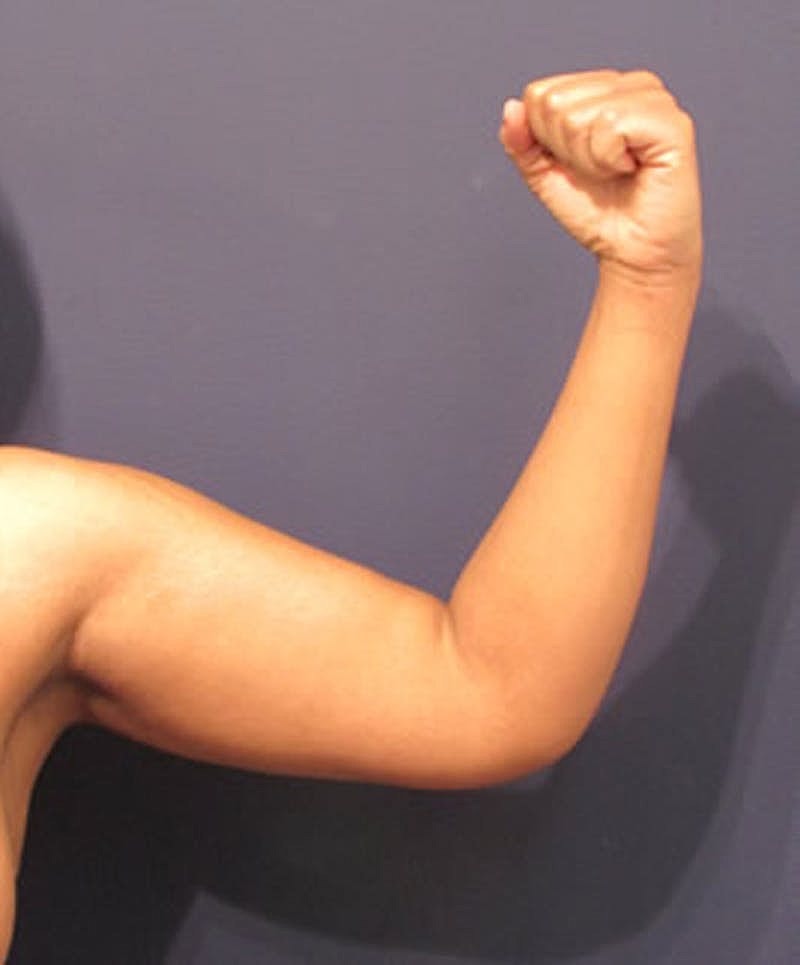 Liposuction Before & After