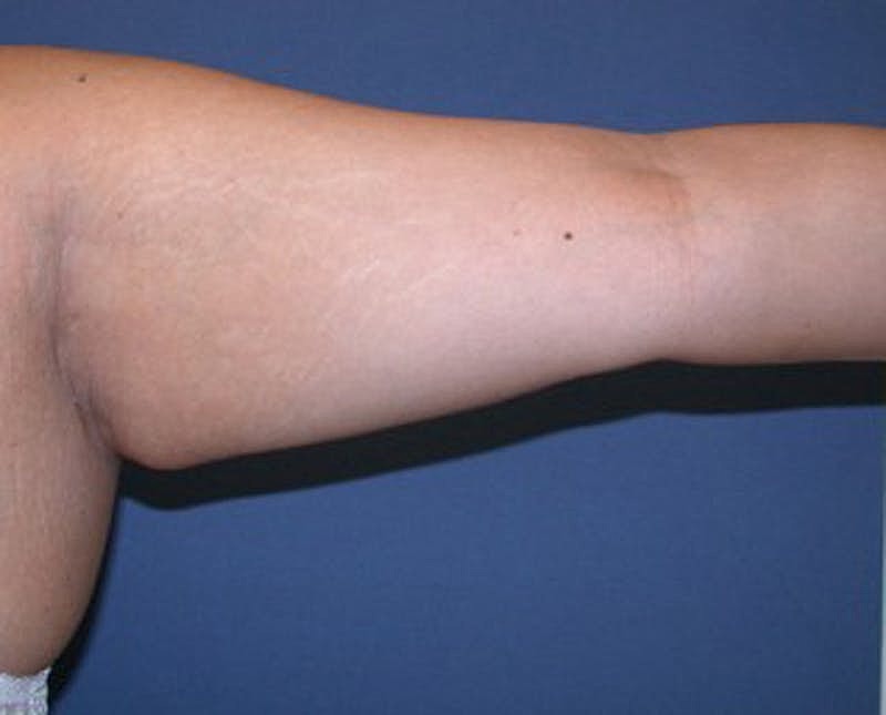 Liposuction Before & After