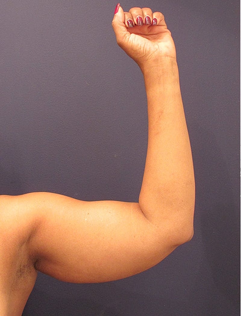 Liposuction Before & After