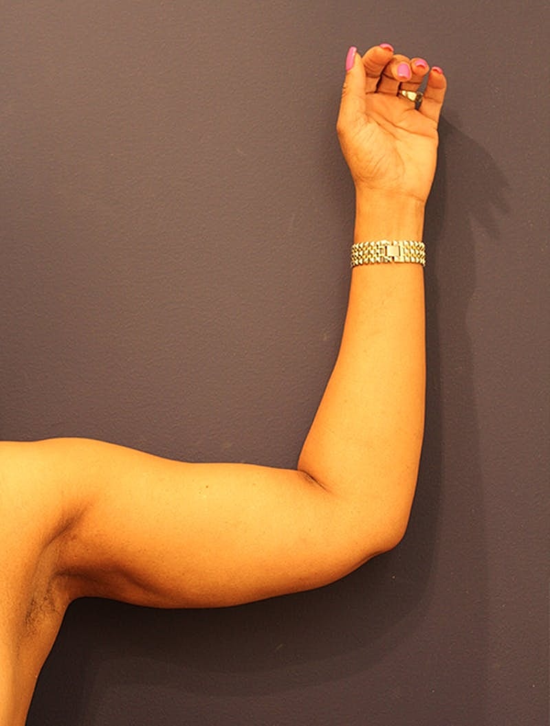 Liposuction Before & After