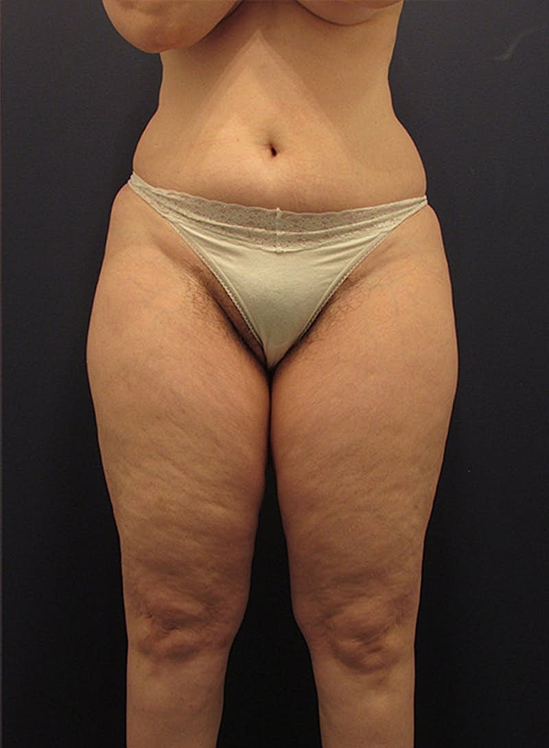 Liposuction Before & After