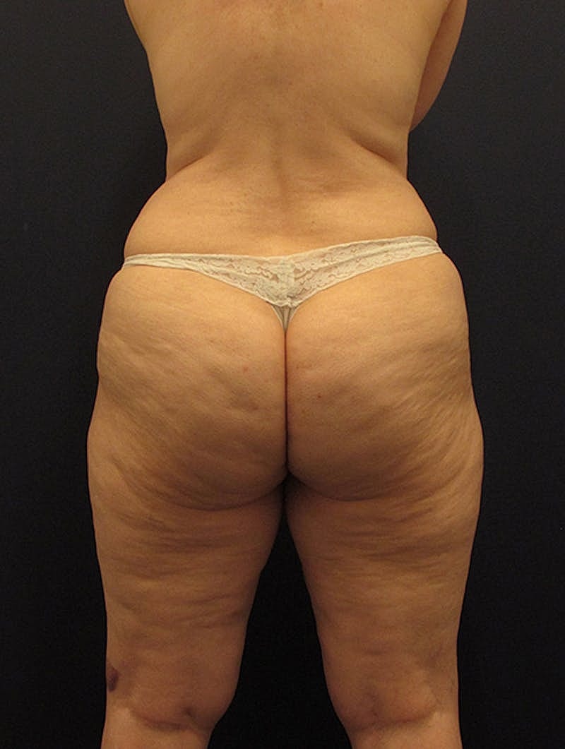 Liposuction Before & After