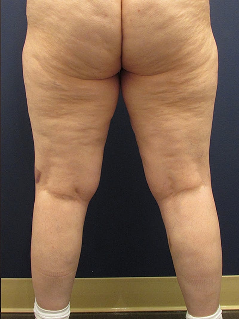 Liposuction Before & After