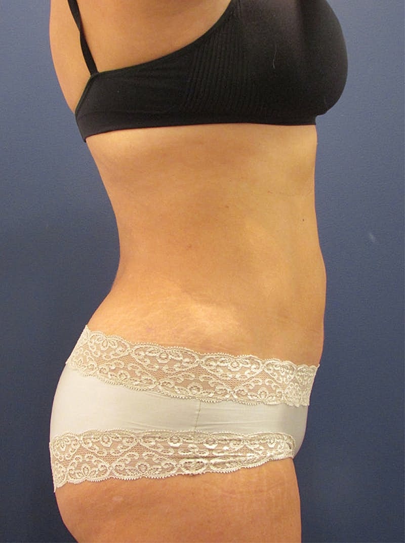 Liposuction Before & After