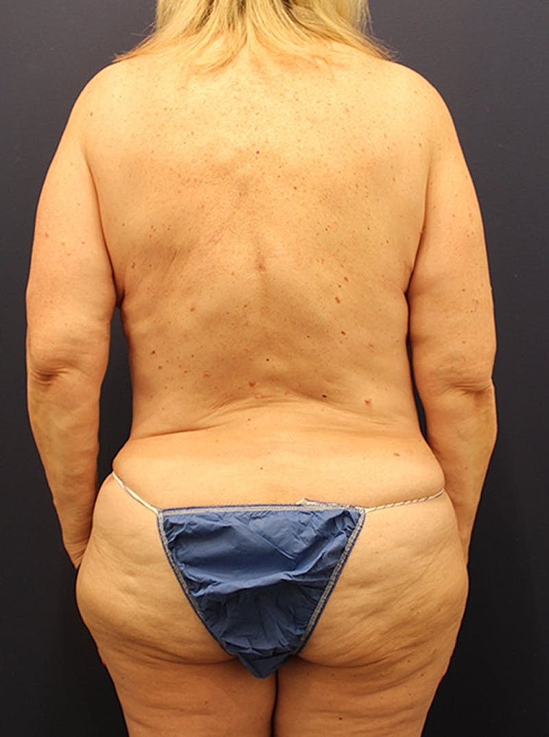 Liposuction Before & After