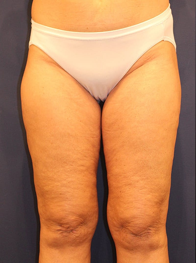 Liposuction Before & After