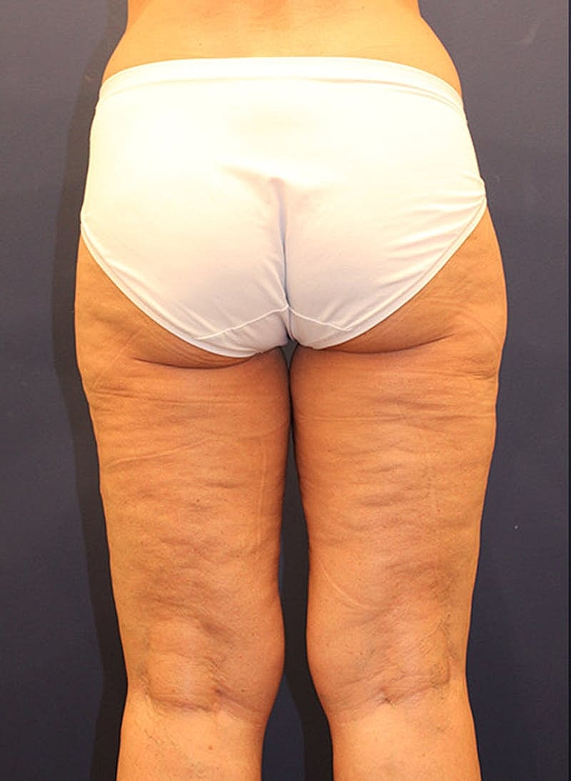 Liposuction Before & After