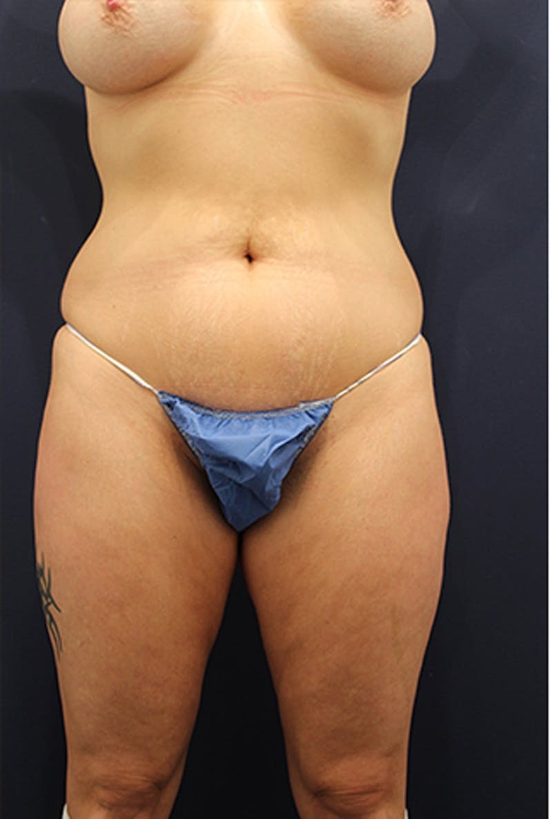 Liposuction Before & After