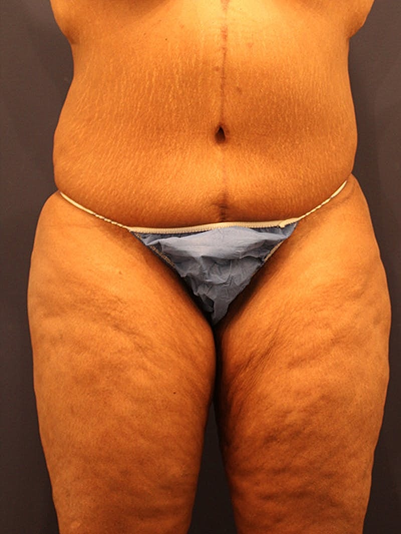 Liposuction Before & After