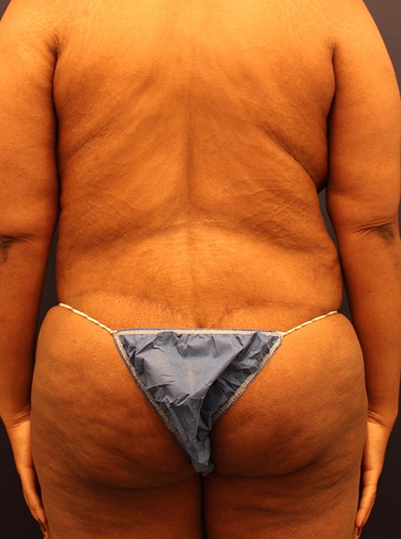 Liposuction Before & After