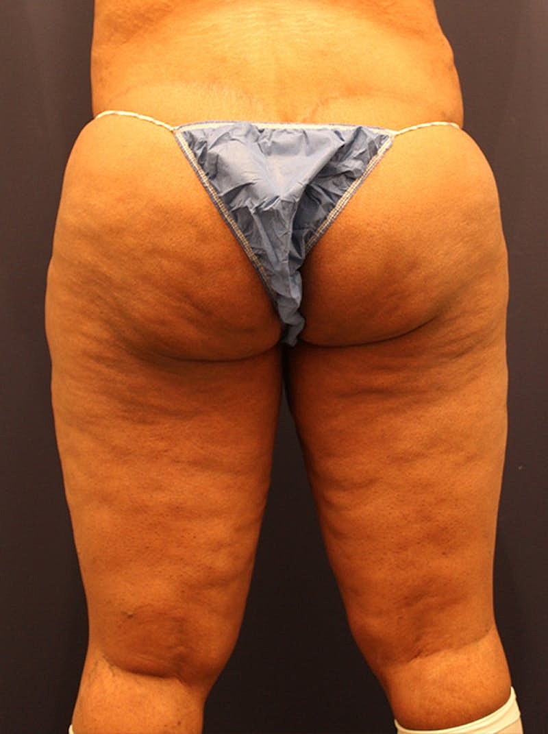 Liposuction Before & After