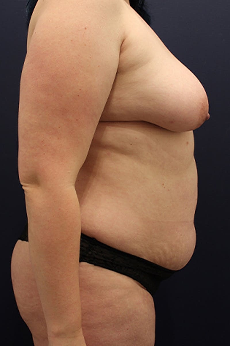 Liposuction Before & After