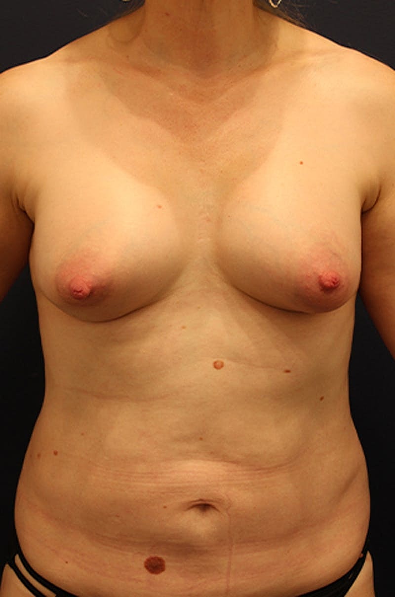 Liposuction Before & After