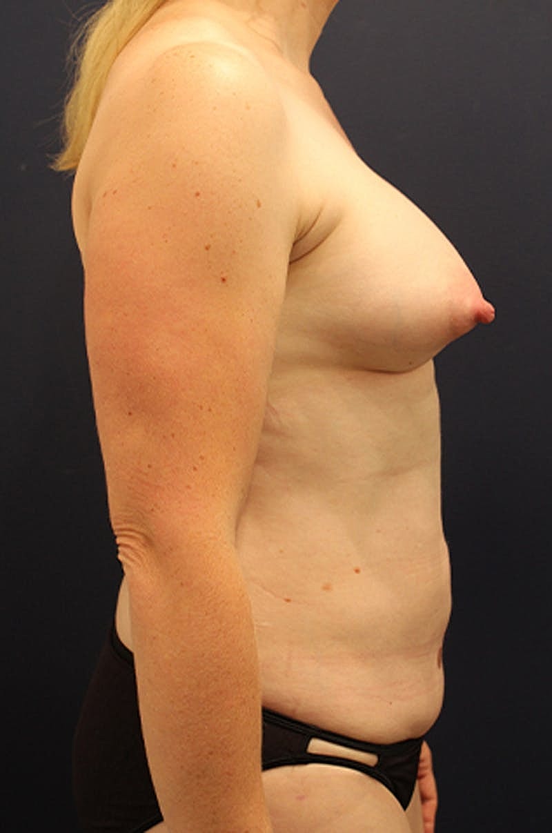 Liposuction Before & After