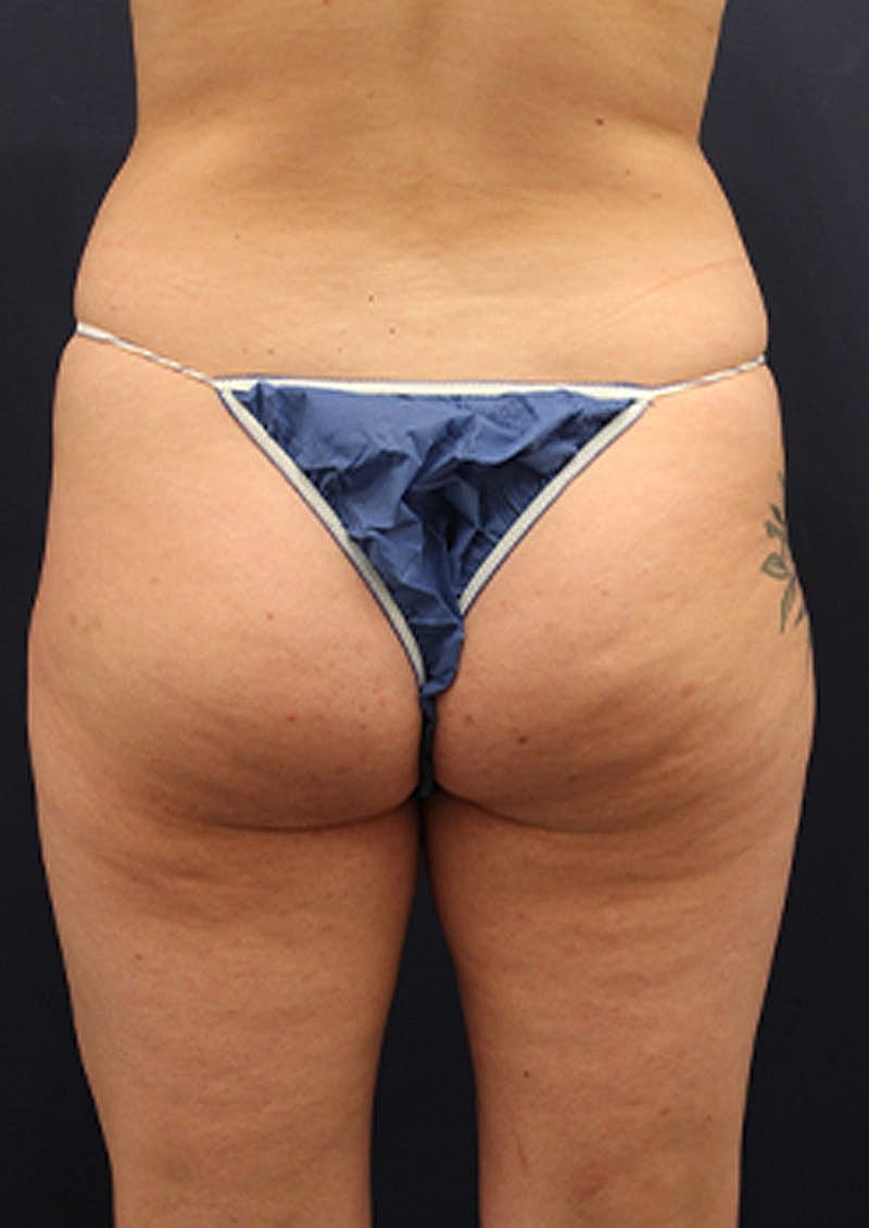 Liposuction Before & After