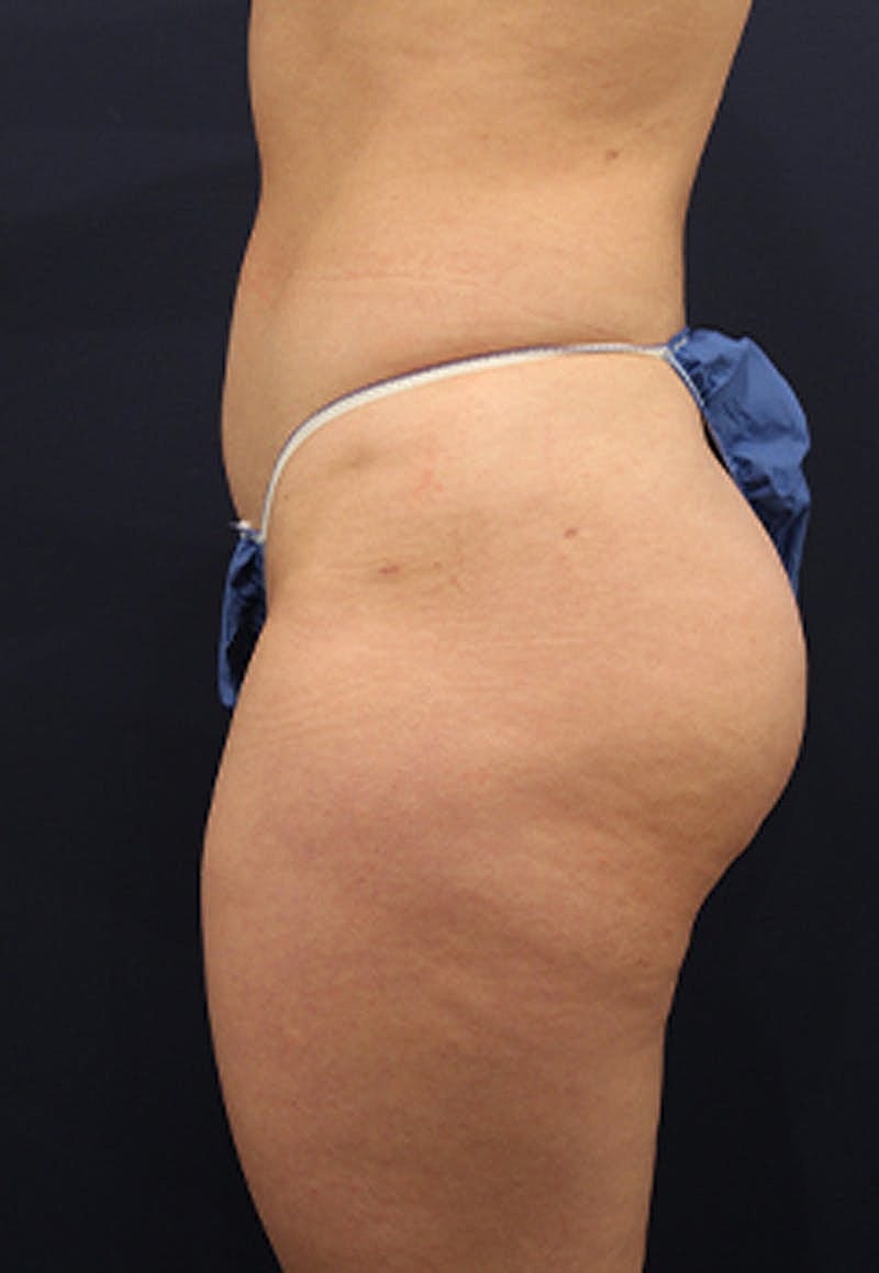 Liposuction Before & After