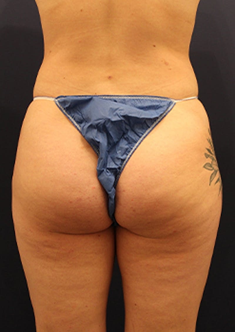 Liposuction Before & After