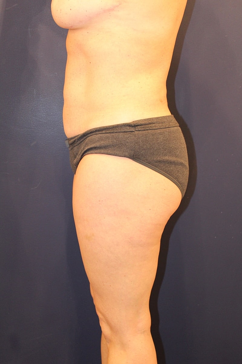 Liposuction Gallery Before & After