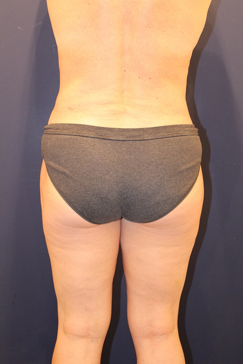 Liposuction Gallery Before & After