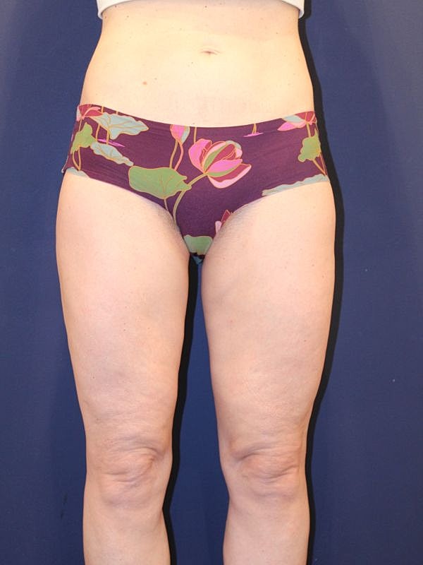 Liposuction Gallery Before & After